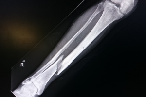 Expert fracture surgeries at a trusted hospital in Kadapa, ensuring quality orthopedic care.